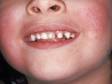 This image displays the appearance of "slapped cheeks" typical in fifth disease.