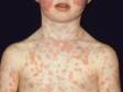 Fifth disease causes a rash on the cheeks and a more widespread rash that typically involves the trunk and arms.