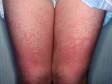 This image displays the extensive rash typical of fifth disease (erythema infectiosum).