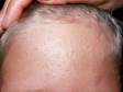Numerous skin colored flat warts are seen here on the forehead.