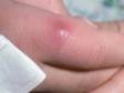 Furuncules (boils) can occur anywhere, including on the fingers.