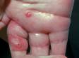 When furuncles (boils) are clustered, they can sometimes be confused with other infections, such as herpes.