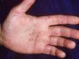 This image displays small blisters on the palm and fingers typical of hand-foot-and-mouth disease.