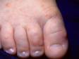 This image shows blisters on the top of the foot and toes typical of hand-foot-and-mouth disease.