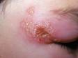 Though more common near the lips, grouped blisters (vesicles) can occur anywhere in herpes infections.