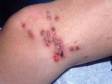 With a herpes virus skin infection, such as this one involving the leg, some blisters (vesicles) can have pus.
