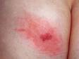 Herpes virus infections can occur virtually anywhere on the body.