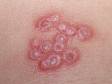 The small blisters (vesicles) of herpes virus infections often have surrounding redness.