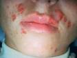 Impetigo is a superficial skin infection caused by staph or strep bacteria. The crusting on the surface of the skin seen on the upper left lip is typical of impetigo.
