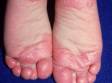 This image displays redness and scaling at the bottom of the feet typical to juvenile plantar dermatosis.