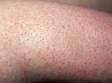 The pronounced appearance of each hair follicle is typical of keratosis pilaris.