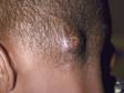 This image displays a kerion with a large lesion with pus-filled bumps present.