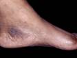 This child has been rubbing or scratching the area between the heel and the ankle, leading to dark, rough areas of thickened skin known as lichen simplex chronicus.