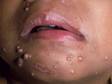 Molluscum lesions may be numerous and pearl-like in appearance; some spots on the child's chin show the characteristic indentation in the center.