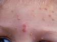 This image displays lesions from a skin infection with a poxvirus, molluscum contagiosum.