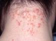 Children with head lice often have multiple scratched areas on the back of the neck and behind the ears.