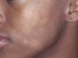 Pityriasis alba can cause light patches of skin, typically involving the face, in people with darker skin.
