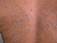 This image displays the round or oval lesions of pityriasis rosea following skin lines like "Christmas tree branches" on the patient's back.