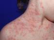 This image displays the pink, slightly scaly skin patches typical of pityriasis rosea.