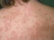 This image displays a rash with slight scaling that is typical of pityriasis rosea.