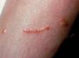 This image displays allergic contact dermatitis due to exposure to poison ivy.