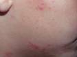 The irregular bumps of early poison ivy dermatitis may resemble acne when on the face.