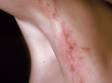 This image displays the line-like configuration of the inflamed skin lesions typical of poison ivy.
