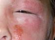 Poison ivy often causes facial swelling and "weepy" skin lesions.