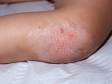 This image displays a knee affected by psoriasis.