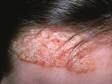 Redness and silver-looking scaling often affect the scalp and hairline with psoriasis.