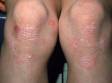 This image displays psoriasis affecting the knees due to excess friction from play and sports.