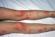 Redness and thick scaling of the slightly elevated lesions is common with psoriasis.