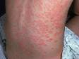 This image displays an extensive case of psoriasis that has been triggered by a strep infection.