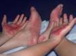 This image displays psoriasis that affects only the patient's palms and soles (palmoplantar psoriasis).