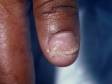 This image displays a nail that is lifting up (onycholysis) due to psoriasis.