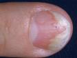 This image displays small pits and discoloration of the nail surface typical of psoriasis of the nail.