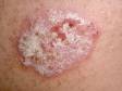 Psoriasis often has white, thick scale that comes off in "plates" when picked, causing bleeding.