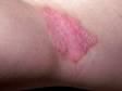 When psoriasis involves body fold areas (known as psoriasis inversus), there is not as much scaling due to moisture.
