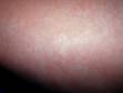 In roseola (sixth disease), the rash is pink to red and is typically widespread.