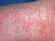 This image displays the rash associated with rubella (German measles).