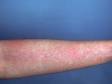 This image displays a fading rubella (German measles) rash.