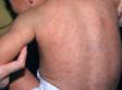 This image displays countless small pink spots that have spread on the body typical of German measles.