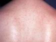 This image displays the pink or red 2-3 mm spots that spread down to the trunk and limbs typical of rubella.