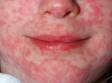This image displays the measles rash, which typically starts on the face and then spreads down the body.