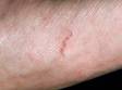 This image displays a track on the skin, known as a burrow, typical of scabies.