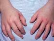 This image displays sores, bumps, and scabs in the finger and wrist area typical of scabies.