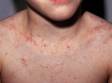 A child with scabies will often have a rash with small red bumps and scabs from scratching on the trunk and limbs.