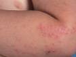 A child with scabies may have extensive involvement of all body areas. Scabies lesions are small red bumps that are often scratched due to their intense itch.