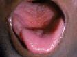 This image displays the sandpaper-like appearance on the chin and a red tongue with red dots (red strawberry tongue) typical of scarlet fever.