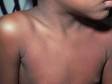 This image displays the faint pink sandpaper-like rash of scarlet fever on the neck and trunk.